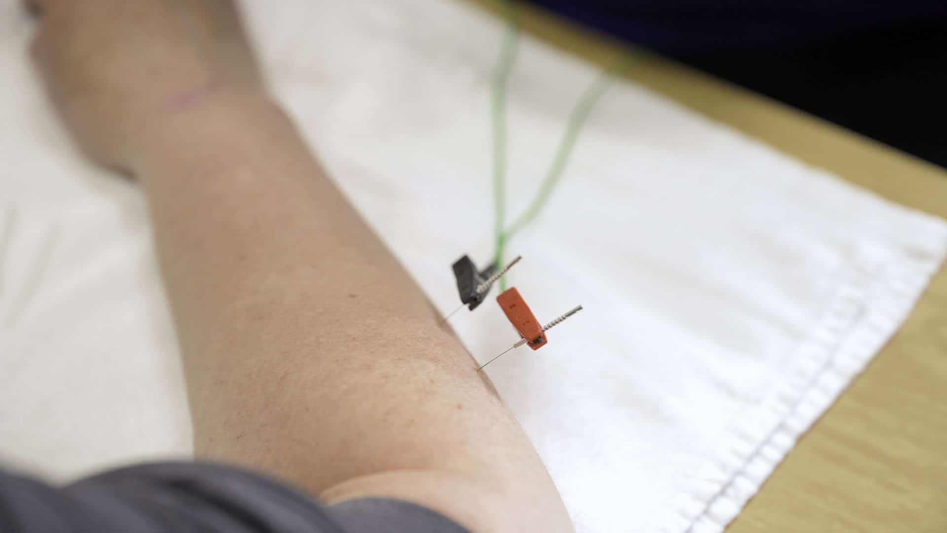 Dry Needling
