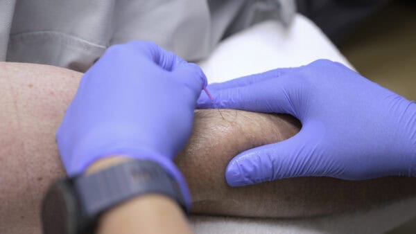 Dry Needling