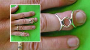 Hand with finger splint and ring, focusing on finger rehabilitation.