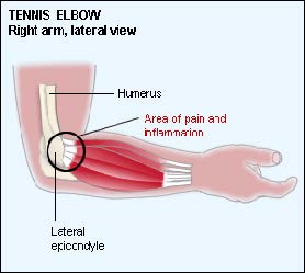 Fly Fisher's Elbow: Tennis Elbow Anatomy
